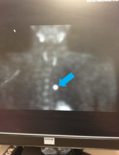 Sestamibi or Parathyroid Scan - Shows an ectopic adenoma in the chest (bright dot in the lower part)