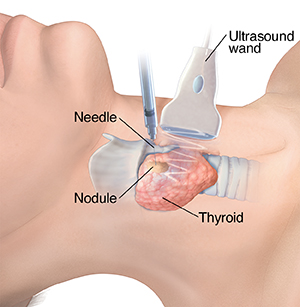 Lateral view of neck showing thyroid with nodule. Ultrasound probe on neck and biopsy needle in nodule.  SOURCE: Original art, based on AEndo_20130624_v0_001.  Used in 11A11986