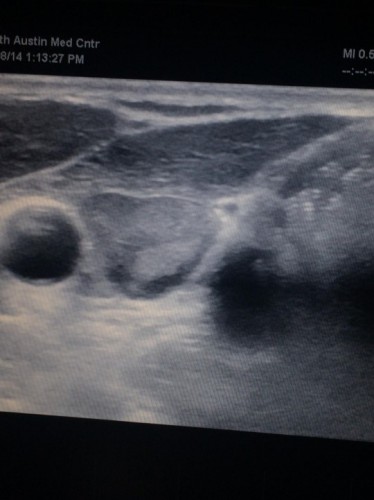 Parathyroid ultrasound showing a large parathyroid adenoma